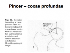 Femoroacetabulær impingement: PINCER
Coxae profundae