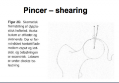 Femoroacetabulær impingement: PINCER 
Shearing
