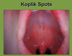 Similar to Rubella
1. 3 C's  and a P= Cough, coryza (inflammation of the mucosal membranes of the nose), conjuntivitis, and P for photobia
2. Koplik Spots =  maculopapular rash (little grains of sand surrounded by erythema); from the ears down
...