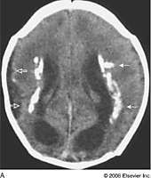 Microcephaly
Periventricular calcifications
Thrombocytopenic petechiae
Sensorineural hearing loss