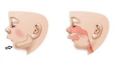 Mandibular hypoplasia
Cleft palate
Tongue falls back --> high risk for airway obstruction