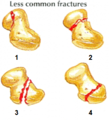 Name these less common scaphoid fracture types.