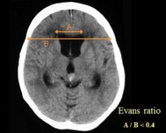 excess fluid within ventricles 


 


Evan's ratio = Ventricular width/ biparietal width


(Normal <0.4) 