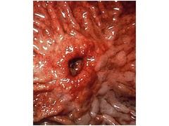 Acute gastric ulcer associated with CNS injury