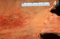 Acute gastric ulcer associated with severe burns