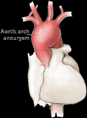 Aortic aneurysm, arch