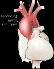 Aortic aneurysm, ascending