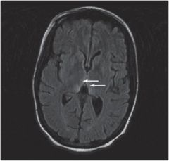Wernicke encephalopathy (thiamine deficiency causing ataxia, ophthalmoplegia, and confusion)