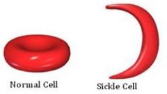 Sickle cell anemia (hemoglobin S)
