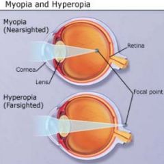 abnormal refraction in which light rays focus in front of the retina 