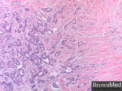 Infiltrating ductal carcinoma