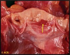 Libman-Sacks endocarditis (nonbacterial, affecting both sides of mitral valve)