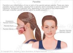 inflammation of the parotid salivary gland 