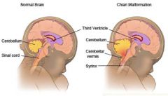Cerebellar tonsillar herniation