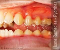 purulent periodontal disease 