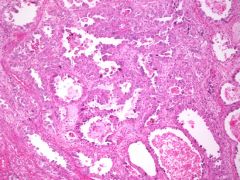 Clear cell adenocarcinoma of the vagina