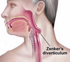 Zenker diverticulum (diagnosed by barium swallow)