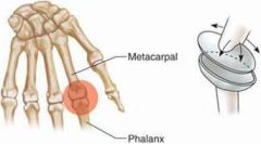 -radiocarpal joint (wrist) 

-metacarpophalangeal joint (knuckle)