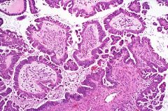 Ovarian tumor (malignant)