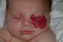 Hemangioma (usually regresses spontaneously by childhood)