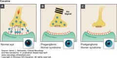 1. Cocaine blocks the reuptake of norepinephrine released at the neuromuscular junction of the iris dilator muscle, allowing for more local availability of norepinephrine. 

image 81

A sympathetically denervated eye will not respond to cocaine be...