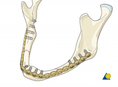 Mandible defects <5cm = mandibular reconstruction bar to span the bony defect and a soft tissue flap

Mandibular defects >5cm - usually require a composite flap such as fibular osteocutaneous free flap