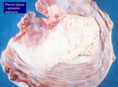 * Ivory white, calcified, benign pleural plaques
- Ferruginous bodies - macrophages phagocytose asbestos fibers and coat them w/ ferritin (iron and protein)
- Diffuse interstitial fibrosis (asbestosis)