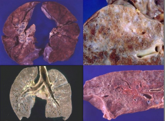 Sarcoidosis:
- UL: lung parenchyma is not that badly affected yet
- UR: big patchy areas
- LR: small cystic spaces
- LL: honeycomb cysts