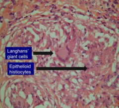 - Langhans' Giant cells (white)
- Epithelioid Histiocytes (purple)