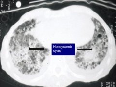 Honeycomb appearance of lung