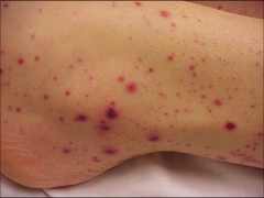 petechiae and purpuric lesions occurring after viral infection (usually 1-6 weeks)


thrombocytopenia but LARGE platelets with high MPV


Treat with IVIG and steroids. Transfuse if 