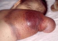 infants with large, congenital vascular tumors (similar to hemangiomas) causing severe consumptive coagulopathy