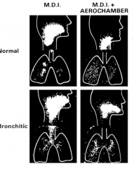 Use aerochamber to get more of the drug into the lungs