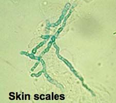 i.	Micro- and macroconidia scrapings from lesion