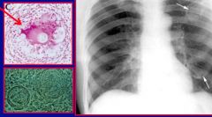 i.	Flu-like
ii.	Initial pneumonia followed by erythematous skin rash
iii.	Eventual skin ulcers and abscesses