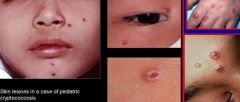 i.	Mild lung infection
ii.	Skin lesion
iii.	Meningitis