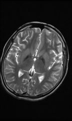 Bilateral areas of hyperintensity within a hypointense medial globus pallidus on T2-weighted images