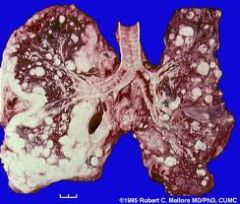 Rapid progression
Bony invasion
Metastasis to LN, marrow, brain & lung