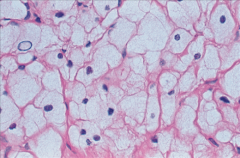 Large cells
Abundant foamy cytoplasm