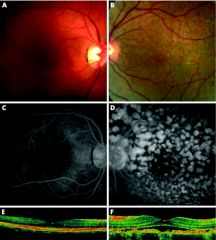 B-scan:  diffuse choroidal thickening and discrete nodules with medium to high internal reflectivity.

Goldmann visual fields: scotomas corresponding to the pigmented tumors and a generalized decreased peripheral visual field.