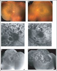 Multifocal areasof early hyperfluorescence corresponding to the red patches
