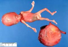 1 egg, 2 sperm
Empty egg fertilized by two sperm 
None survive
well growth fetus
normal or small head 
large placenta w appearance of partial hydatiform mole 
3rd and 4th finger syndactyly