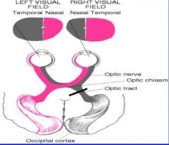 left homonymous hemianopsia- can see temporal w/ R eye and nasal w/ L eye