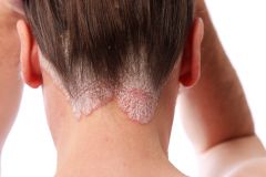 skin redness and irritation; most people with psoriasis have thick, red skin with flaky, silver-white patches called scales