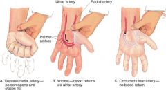 make sure ulnar artery is working if IV is on radial artery