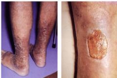 varicose veins- regurgitating blood back to legs
browning will lead to ulcer