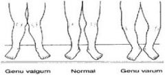 varum- bowlegged; normal until 2/3 yrs

valgum- knock kneed; prominent during 3/4 yrs and can be normal until 6/7 yrs