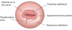 columnar epithelium- more red
*squamocolumnar junction- site of pap smears, common site of cancer
squamous epithelium- more smooth

>> as you age, columnar epithelium moves toward uterus and is not as visible
