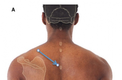 T3 at the root of the scapular spine (trace from scapula)