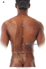 this is T12
it is 1/2 way between the inferior end of the scapula and the highest point of the iliac crest
